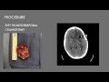 AANS Coding Shorts: Craniotomy for Resection of a Supratentorial Metastatic Brain Tumor