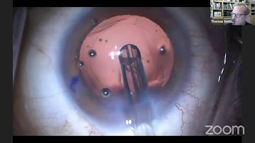 Video Bouquet of Phaco Basics to Advanced - Part 1-Tips For Weak Zonules-Dr.Thomas Oetting