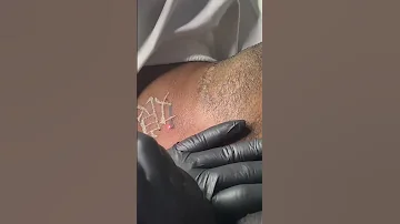 Laser Tattoo Removal Insane Ink Tattoo 0717341855 Tattoo Tattooartist Art Tattootimelapse 