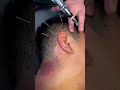 cupping #dryneedling #cupping #trend #massage #foot #head #acupuncture #viral #firecupping #trend