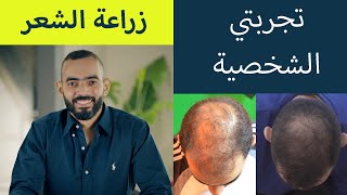 زراعة الشعر - تجربتي الشخصية