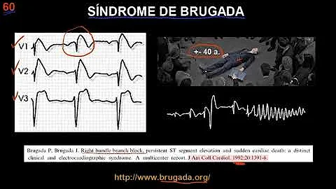 60 BRUGADA SYNDROME | ELECTROCARDIOGRA...  (ECG) ONLINE COURSE