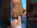Intramuscular Injection Technique Explained | Safe IM Injection Step-by-Step | Nurse Guide Class 33