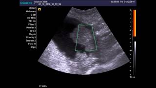 Видео Кистозно солидное образование околопупочной области справа (автор: Дмитрий Горбачев)