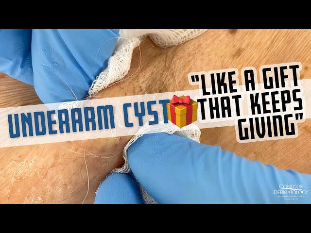 This Underarm Cyst is Like A Gift That Keeps Giving class=