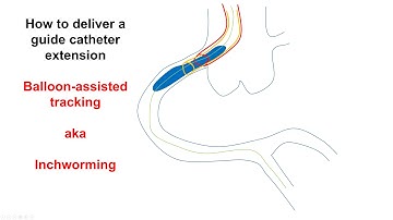 How to deliver a guide catheter extension: balloon-assisted tracking, aka "inchworming"