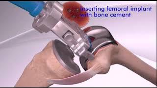 Total Knee Replacement TKR   Animation