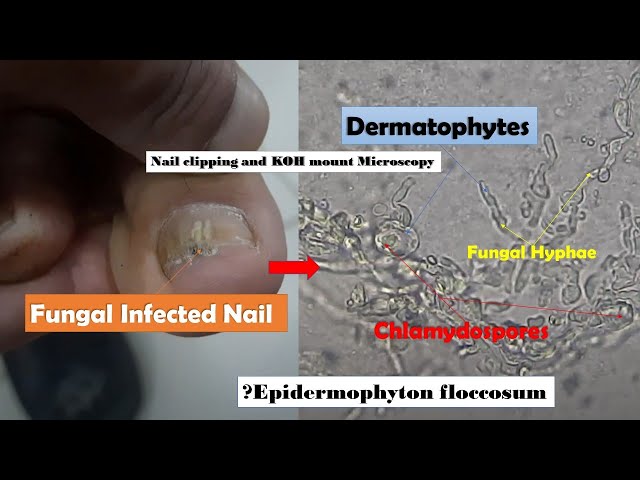 CUTTING SEVERE FUNGAL NAILS INFECTION BY MISS FOOT FIXER MARION YAU -  YouTube
