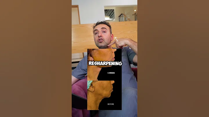 4 Weeks After Deep Plane Face & Neck Lift | Dr. Batal’s Natural Rejuvenation Results