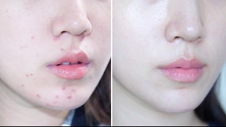 How To Get Rid Of Acne Naturally | Skin Transformation โค Liah Yoo