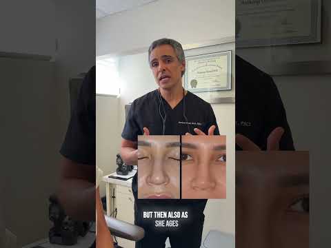 Video thumbnail: Female Rhinoplasty Results, 1 year post-op | Anthony Bared M.D, FACS | Miami, FL · Dr. Anthony Bared, M.D - Facial Plastic Surgeon