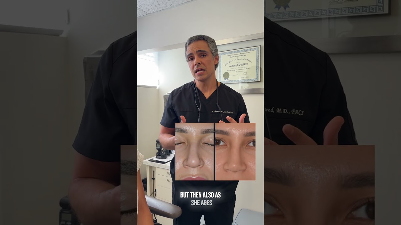 Female Rhinoplasty Results, 1 year post-op | Anthony Bared M.D, FACS | Miami, FL