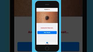 2015 ideas - Skin cancer detection app with access to a dermatologist in seconds :) #ai #skincare screenshot 3