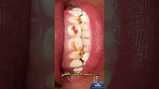 تسمم الأسنان بالفلور| التفلور الزائد للأسنان|Dental fluorosis#fluorosis#dentist #소아치과 #dental #anest