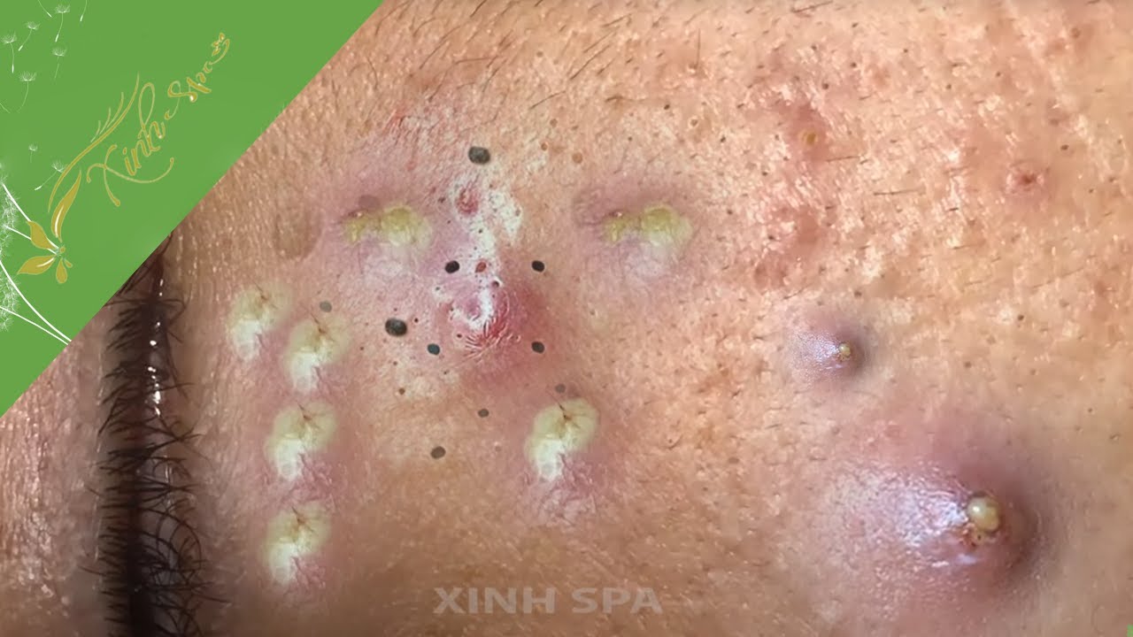Relax Every Day with Xinh Spa Acne Treatment 8147 YouTube