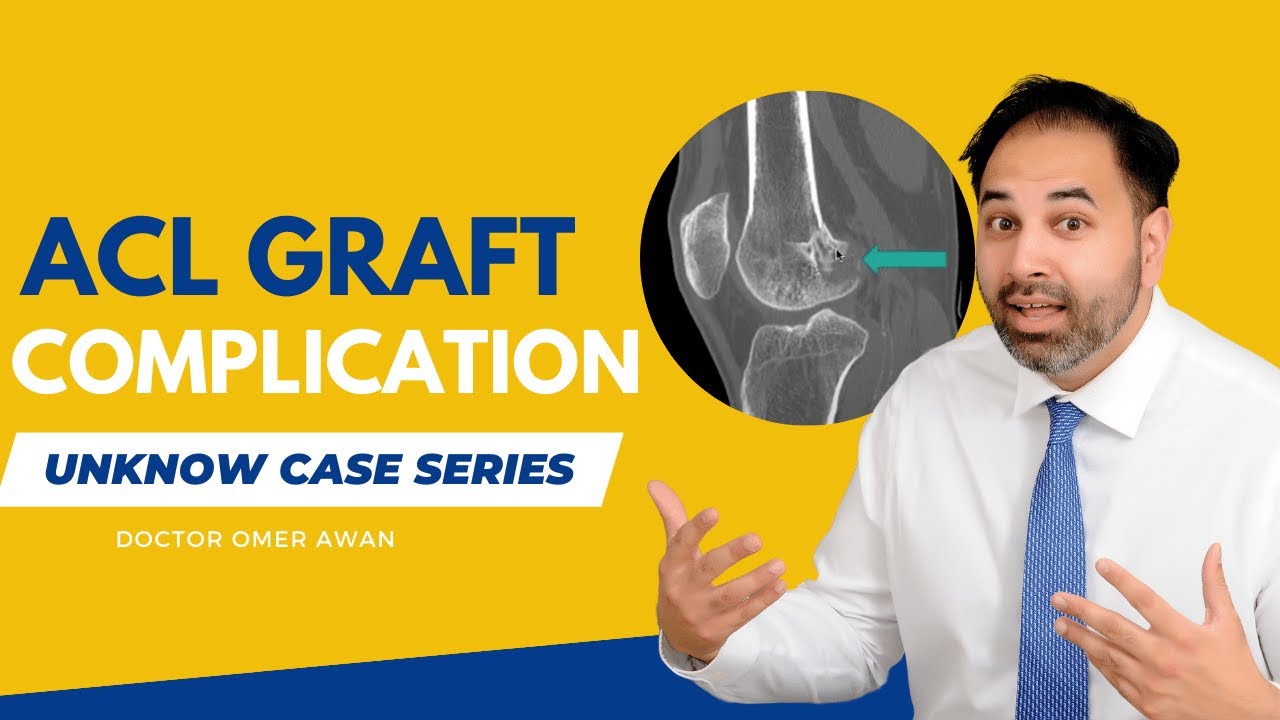 ACL Graft Complication That You Have Never Seen | Dr omer Awan