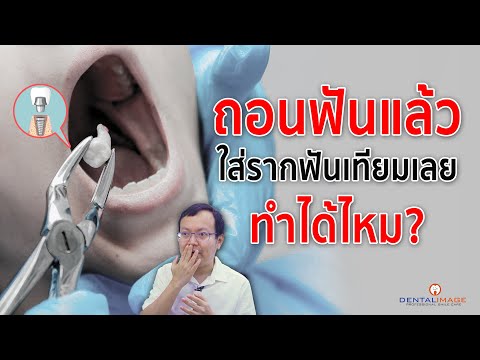 ถอนฟัน แล้วฝังรากเทียมเลยได้ไหม? | รากฟันเทียม By Dentalimage