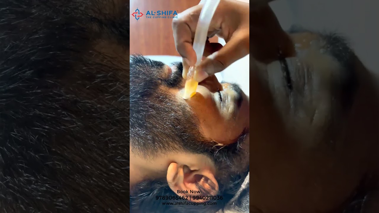 Facial Cupping Treatment by Vj Pappu 