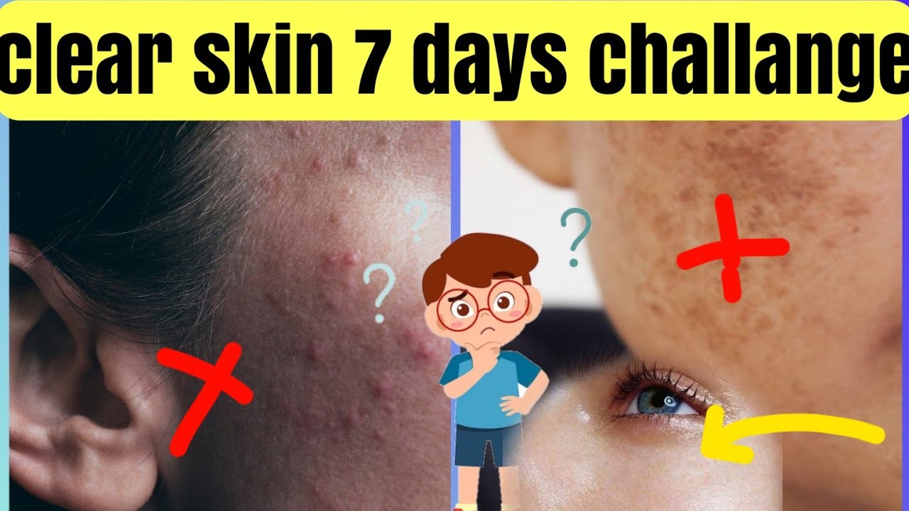 7 Days Clear Skin Challange || Get Rid From "PIMPLES" In Just 7 Days ...