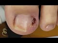 GRANULOMA ENORME DE GRAU 3 #nails #ingrowntoenail