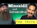 Minoxidil & Dermarolling - The TRUTH!