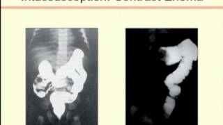 Intussusception