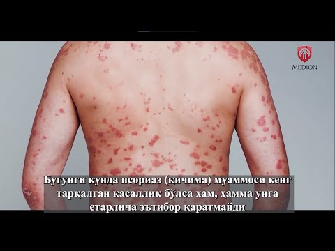 Псориаз. Причины, подробно о лечении, признаки и симптомы псориаза.