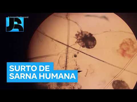 Quase 9 mil crianças estão sem aulas em Lagoa Santa (MG) por causa de surto de sarna humana