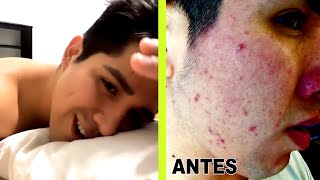 POR ESTO YA NUNCA MÁS ME SALE ACNÉ 😬 - Mi último vídeo de Skin Care