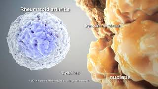 Rheumatoid Arthritis Animation - Cook Children