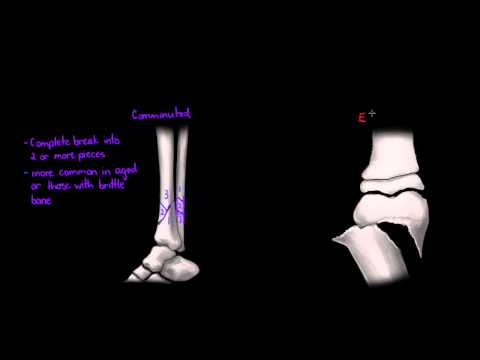Video: Mga Bone Fracture Sa Chinchillas