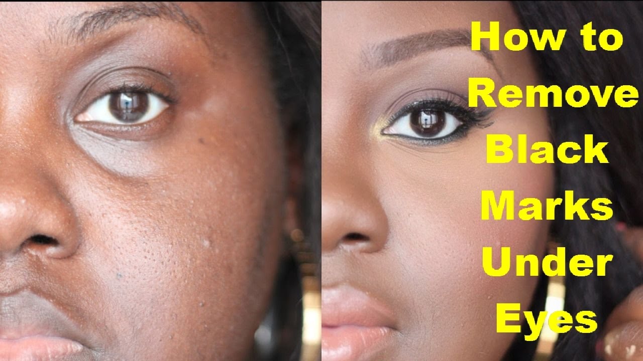 How to Remove Black Marks Under Eyes? Get Rid of Dark ...