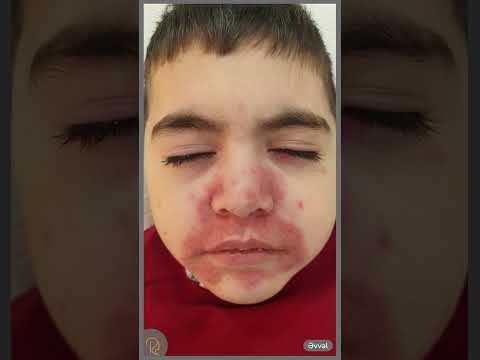 Video: Perioral dermatiti müalicə etməyin asan yolları: 8 addım (şəkillərlə)