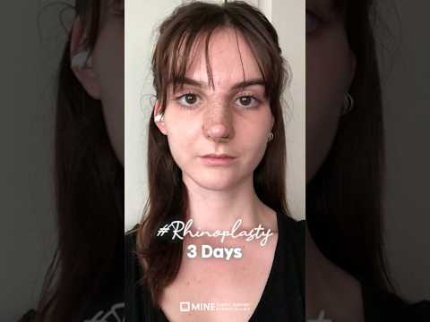 3 days to 3 months!! #rhinoplasty #3days #3months #plasticsurgery