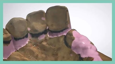 3Shape Dental System™ Removable Partial Framework