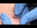 Melanoma Detection: New sticker test predicts cancer diagnosis
