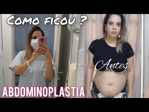 MOSTREI MEU CORPO 3 MESES APÓS ABDOMINOPLASTIA!! #5