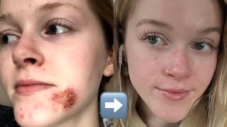 My Accutane Journey! (before and after + what to expect)