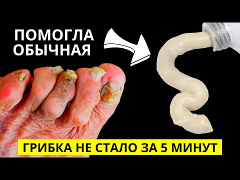 Эта Копеечная Мазь уберёт весь Грибок с ногтей ЗА 5 МИНУТ! Продается в любой Аптеке!