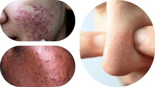 Comédons, Points Noir Et Microkystes