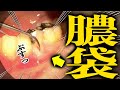 膿が出続けたら骨がドロドロに溶けます 歯医者かおりが治します