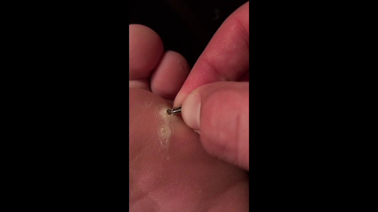 I Have A Plantar Wart Youtube Gaming