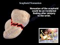 Scaphoid Nonunion  - Everything You Need To Know - Dr. Nabil Ebraheim