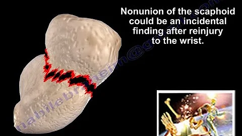 Scaphoid Nonunion  - Everything You Need To Know - Dr. Nabil Ebraheim