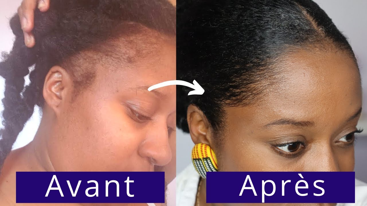 Comment faire POUSSER ses cheveux RAPIDEMENT après l'accouchement? #postpartum #allaitement