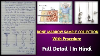 bone marrow sample collection | bone marrow biopsy