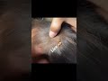 liceinfestation687 #headliceremoval #licecomb #headlice #headlicetreatment #hairlice #haircare #hair