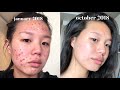 Acne Skincare Routine FINALLY.