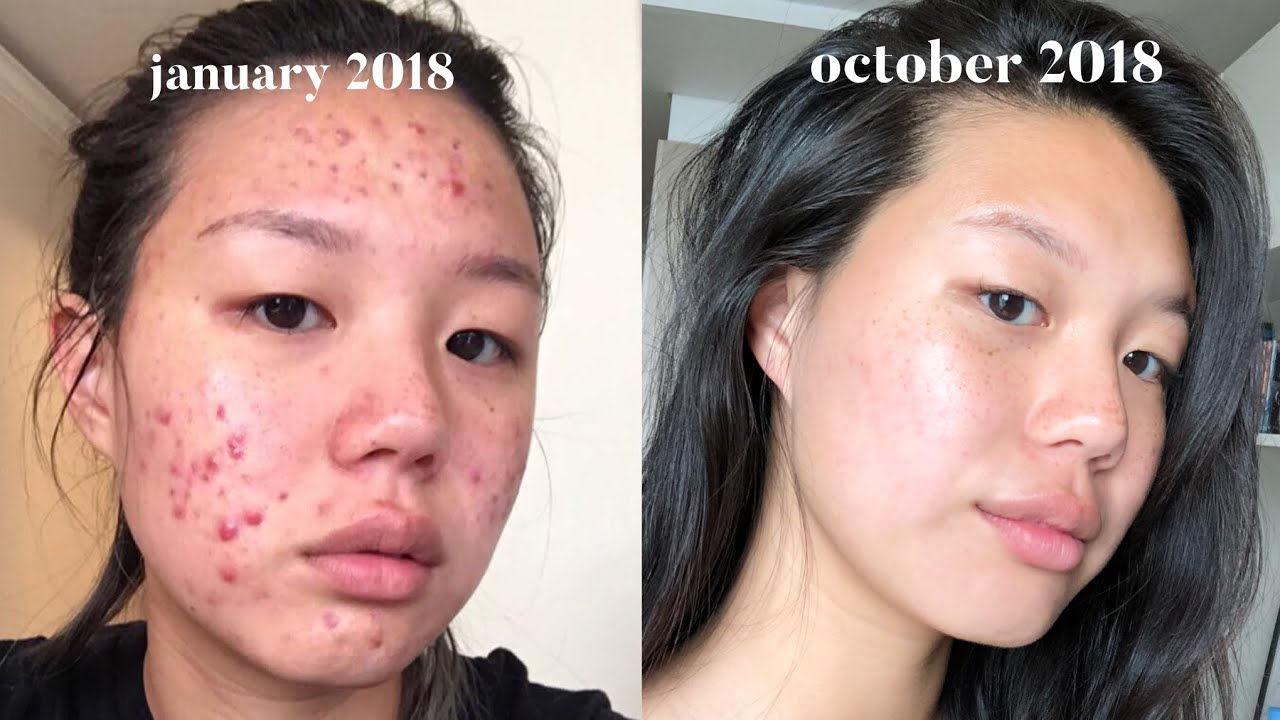 Acne Skincare Routine FINALLY. - YouTube