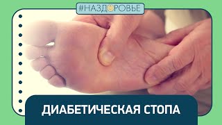 #НАЗДОРОВЬЕ: диабетическая стопа